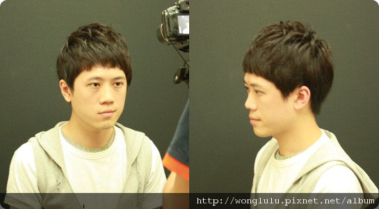 元和雅_膠原蛋白隆鼻_膠原蛋白蘋果肌＿南部高雄台南＿微晶瓷隆鼻案例照片