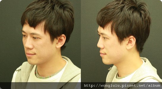 元和雅_膠原蛋白隆鼻_膠原蛋白蘋果肌＿南部高雄台南＿微晶瓷隆鼻案例照片