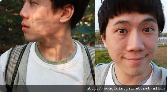 元和雅_膠原蛋白隆鼻_膠原蛋白蘋果肌＿南部高雄台南＿微晶瓷隆鼻案例照片