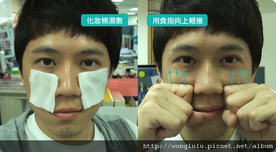 元和雅_膠原蛋白隆鼻_膠原蛋白蘋果肌＿南部高雄台南＿微晶瓷隆鼻案例照片