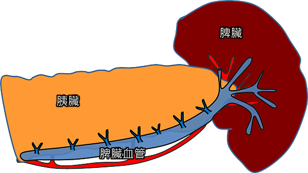 distal pancreas 