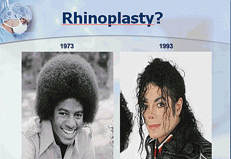 rhinoplasty (M.J)