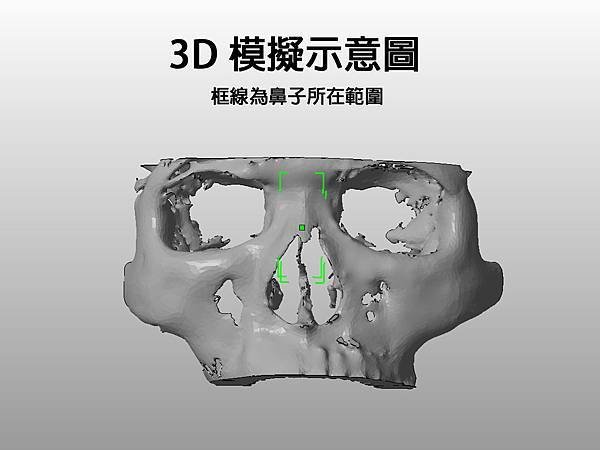 3D圖鼻雕手術02.jpg