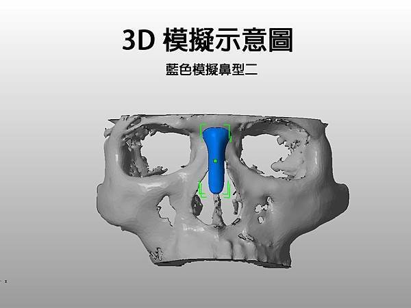 3D圖鼻雕手術04.jpg