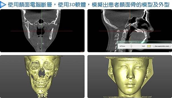 3D設計鼻雕手術.jpg