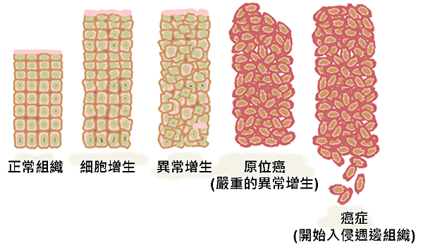 Ch_cancer_progression