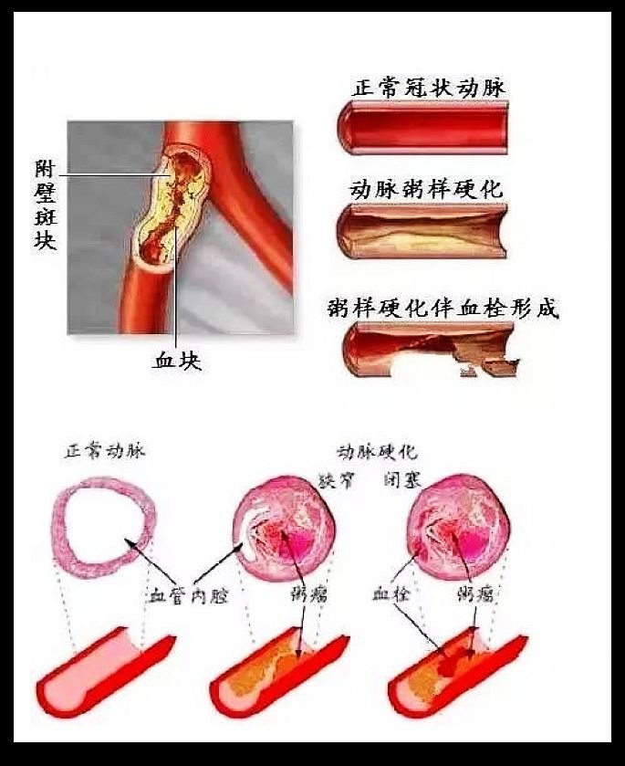 高血壓