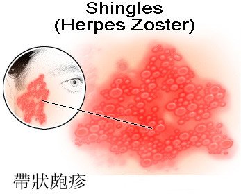 帶狀皰疹