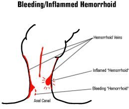 內痔出血