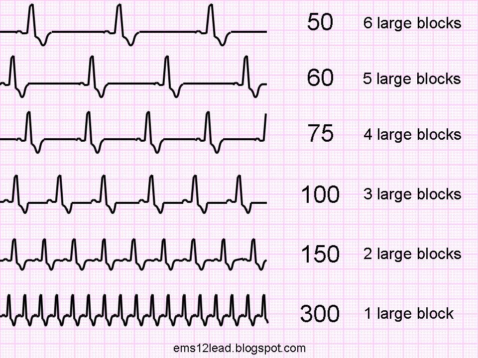 ECG