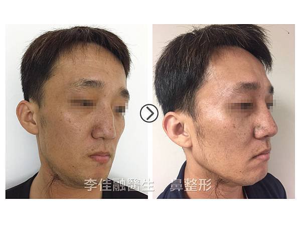 李佳融醫生-自體軟肋骨矯正歪鼻
