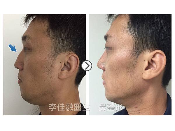 李佳融醫生-自體軟肋骨矯正歪鼻