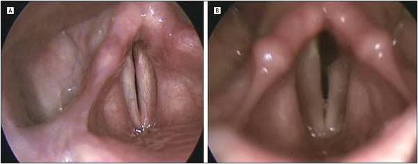 聲帶麻痹-6.jpg