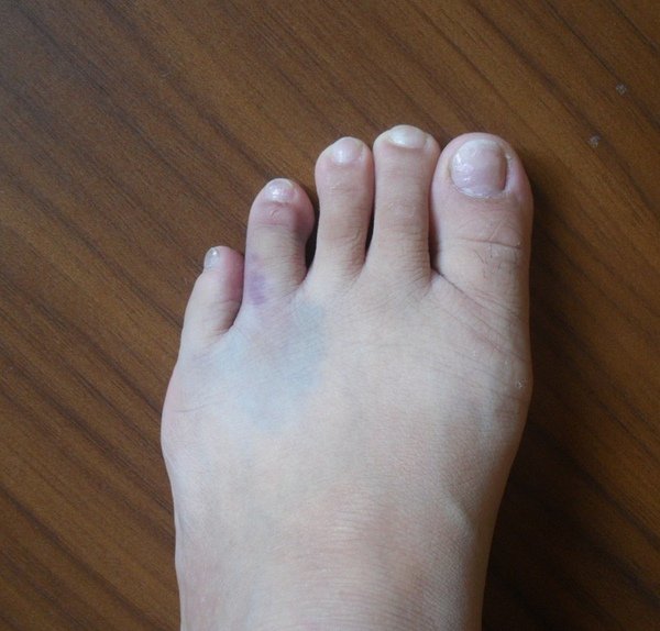 腳趾挫傷