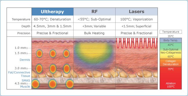 ultherapy-overview