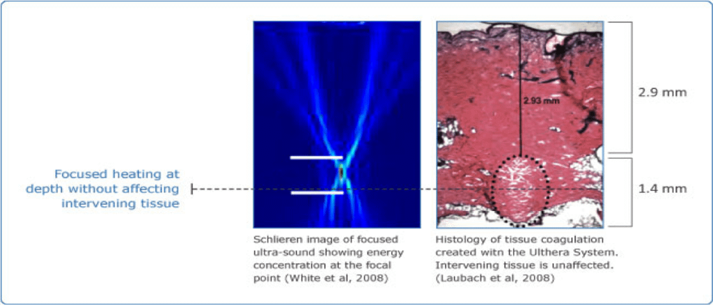 sternlaser_Ulthera_Focused-Heating