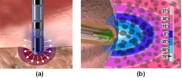 CatheterAblation2