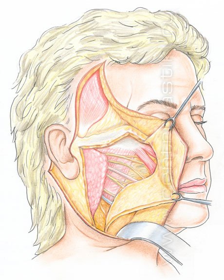 facelifting_s0705