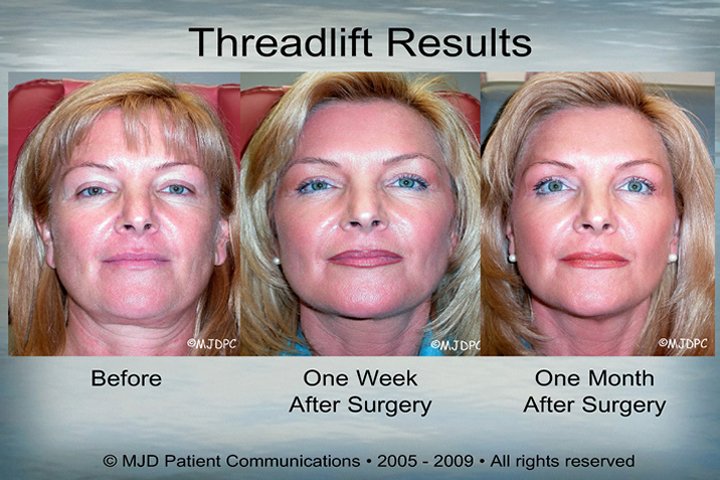 ThreadLift_p06