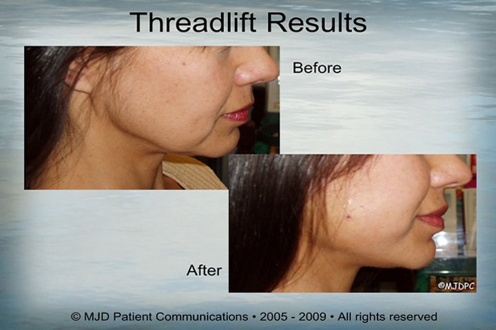 ThreadLift_p15