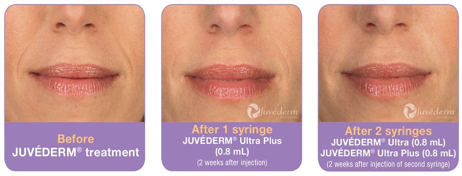 juvederm-before-after-photos