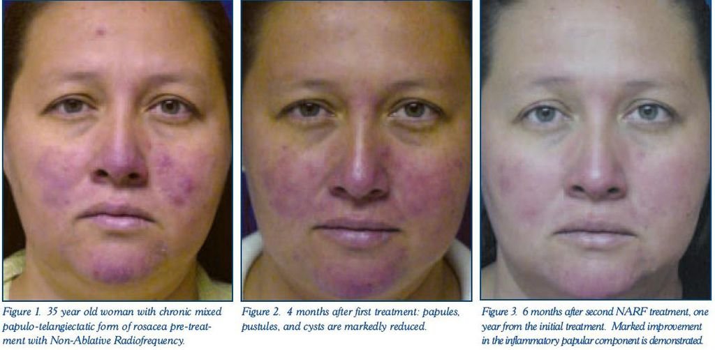 5rosacea Rx with RF