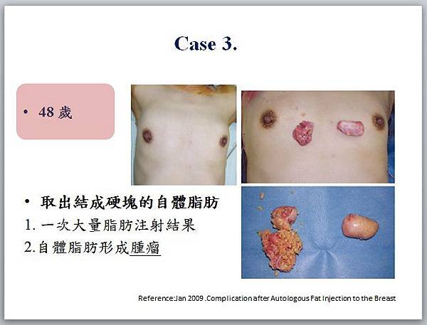 自體脂肪失敗案例03(中文說明)(2)