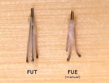 graft-quality_fue-fut_sm