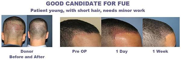 fue_good_candidate_hair_transplant1