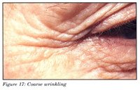 coarse_wrinkling