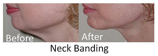 Neck-Banding00