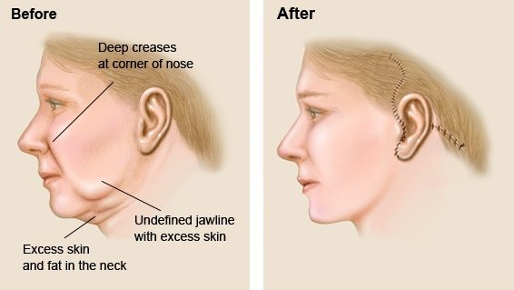 plastic surgery abroad face lift