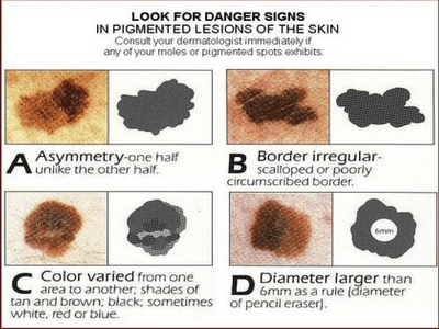 skin_cancer