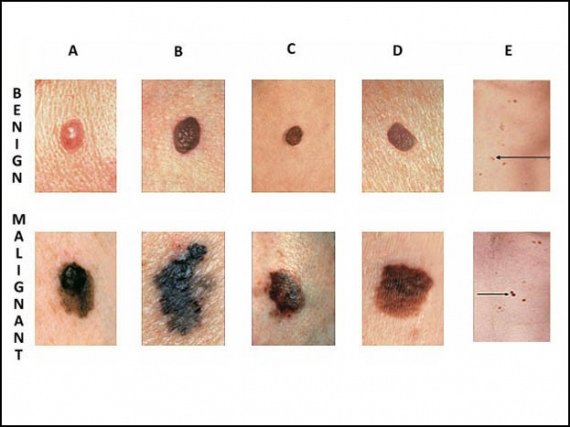 abcde-skin-cancer-chart-636