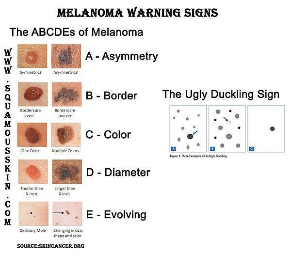 Melanoma-Skin-Cancer-Looks-Like