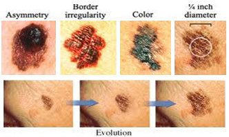 img-skin-cancer