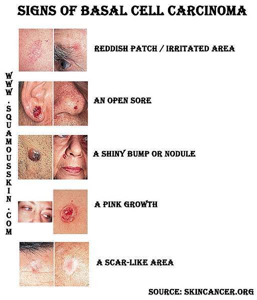 Basal-Cell-Carcinoma-Skin-Cancer-Looks-Like