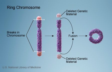 ringchromosome