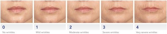 lip-wrinkles-at-rest-scale-fullwith_Contentbreite