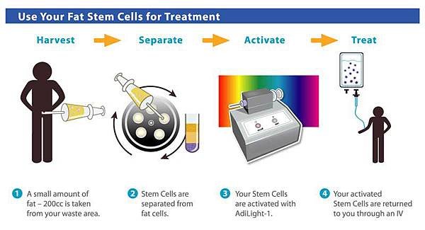 adipose-stem-cell-therapy