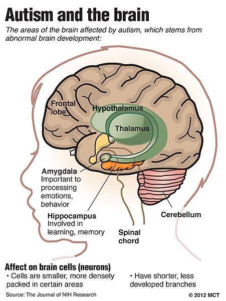 AUTISM_brainInfographic2