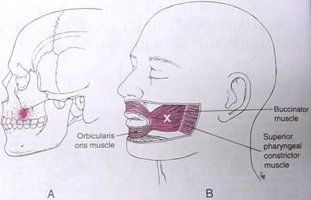 buccinator2