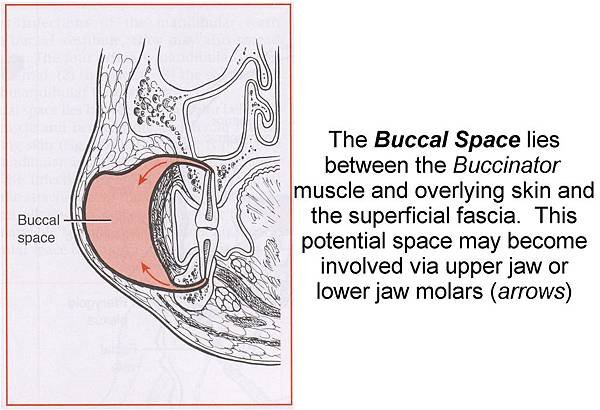 Buccal_Space_Infection