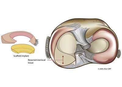 meniscal_scaffold-b_sm