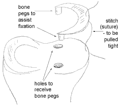 meniscal_replacement