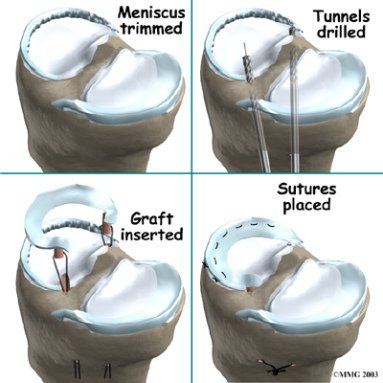 knee_meniscus_transplant01_still