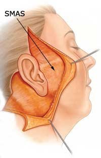 Facelift2_SMAS