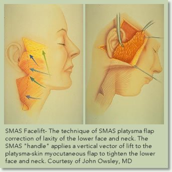 facelift_smas