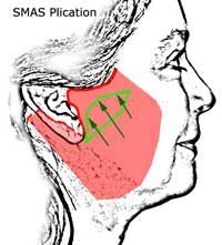 Facelift7_plication