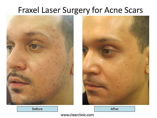 fraxel-acne-scar-treatment-ny